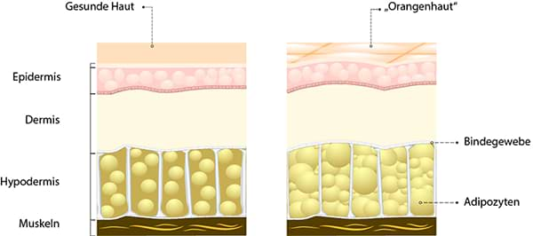 Mit Faszientraining Cellulite Bekampfen Geht Das